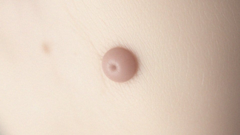 Jak wygląda kaszak? Objawy, przyczyny i metody usuwania